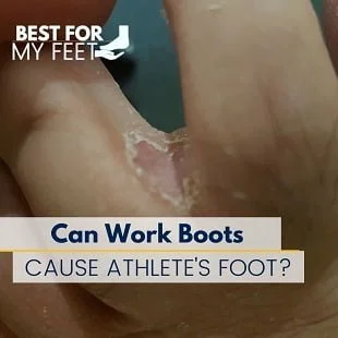 someone suffering from athlete's foot by wearing work boots is showing how the disease looks like