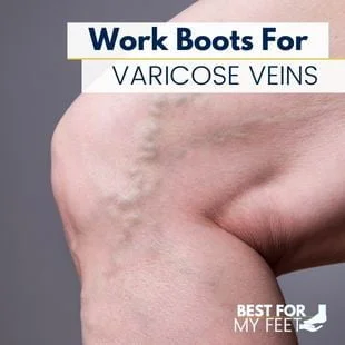 a person's leg with some thick varicose veins.