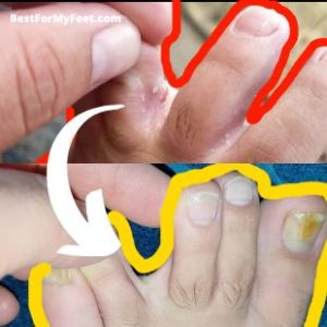 the before and after doing the treatment for getting rid of the Athlete's foot fungus permanently